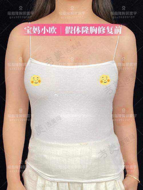 影响假体隆胸能保持多久的因素