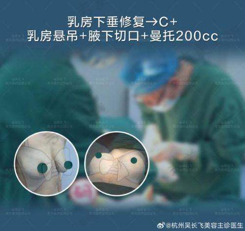 国内部分地区综合的假体隆胸失败修复手术价格