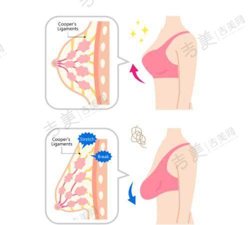 二、丁昆琨拉皮价格公布详情——苹果肌复位提升费用