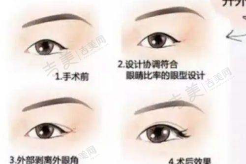 三、丁昆琨拉皮价格公布详情——美国强生鱼骨线全方面部提升价格
