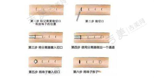 六、花3万多找丁昆琨做面部拉皮成效如何——真人实例分享