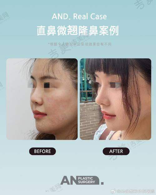 二、师俊莉做鼻子的成效评价：实际实例见真章