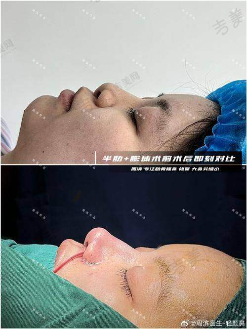 五、师俊莉做鼻子的价格情况：价格背后的价值