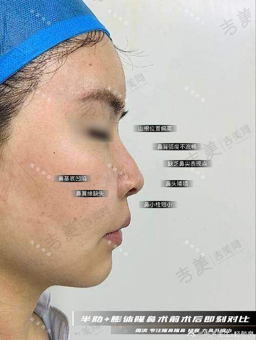 四、师俊莉做鼻子的价格情况：真的贵吗？