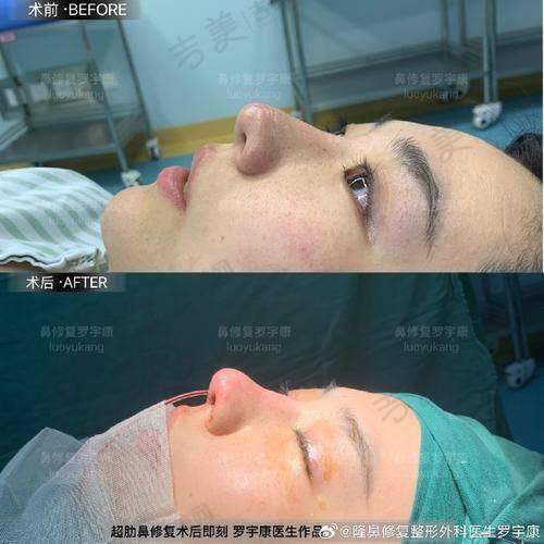 三、师俊莉做鼻子的成效评价：大众口碑怎么样？