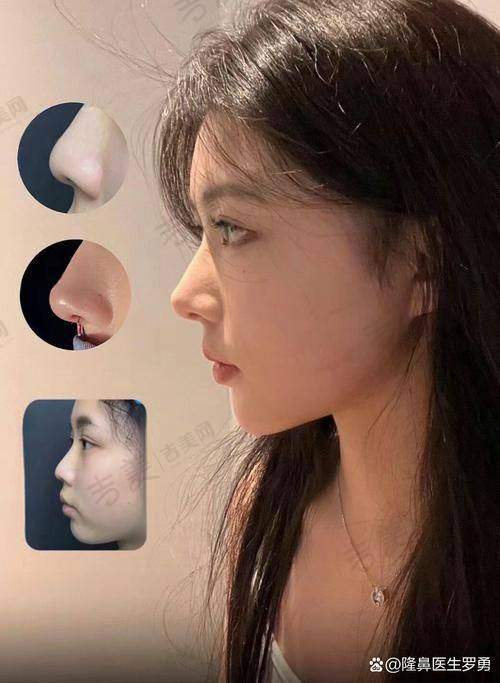 七、深圳张辉做鼻子术后护理要点：术后如何修复得更好？