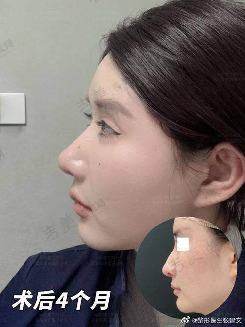 四、深圳张辉做鼻子真人实例成效感受：真实实例告诉你成效