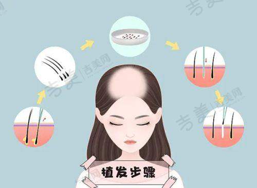 杭州碧莲盛无痕植发地址及乘车路线