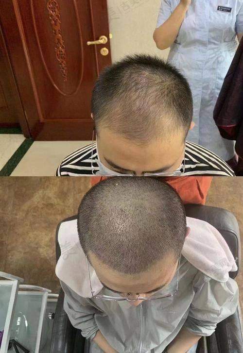 李世涛医生坐诊的福州碧莲盛植发医院
