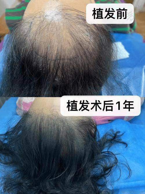 济南碧莲盛植发诊所口碑好不好?附真实患者口碑评价