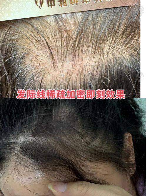 杭州碧莲盛无痕植发怎么样,口碑评价如何?