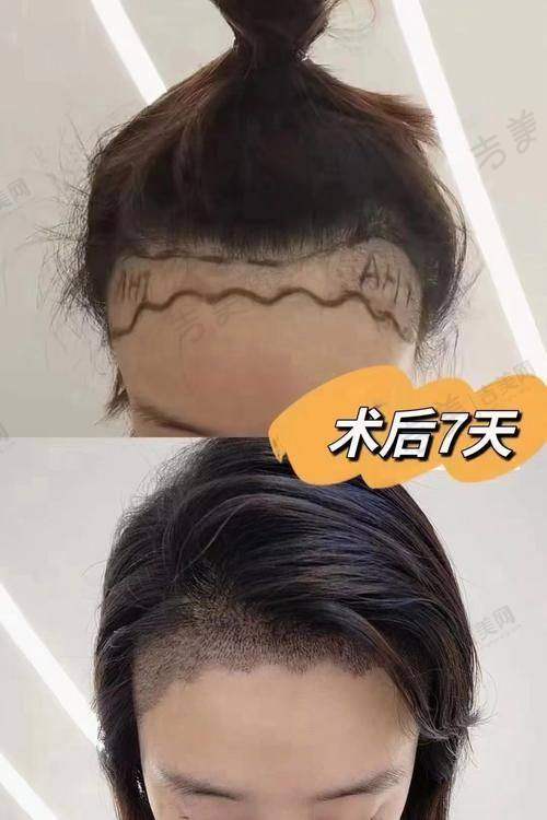杭州碧莲盛无痕植发口碑好不好?附真实患者口碑评价