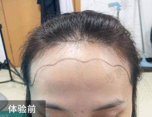 杭州碧莲盛无痕植发价格表