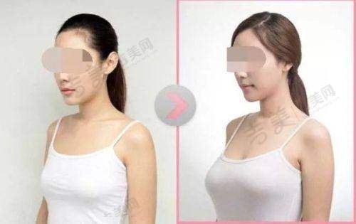 法芮娅假体丰胸躺下硬不硬：双平面动感隆胸术成效
