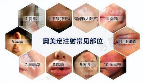 铂蕴假体380跟铂蕴假体350适合人群的区别