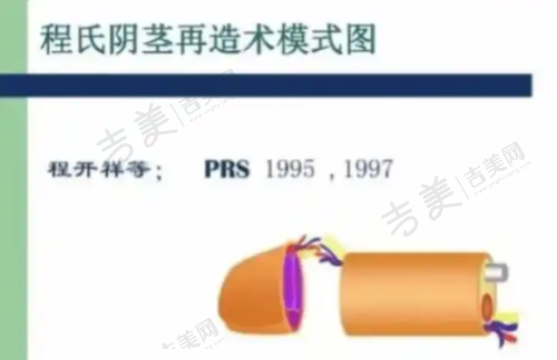深圳景田万晓楠3S人鱼体雕吸脂的适用人群