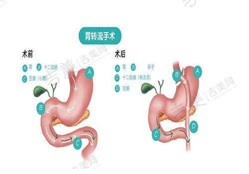 深圳景田万晓楠3S人鱼体雕吸脂的优势