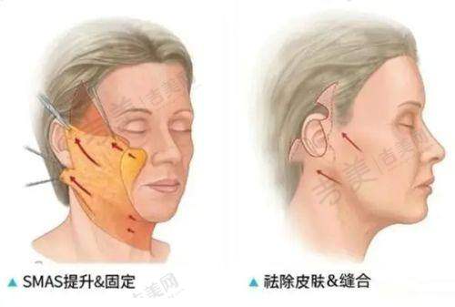 深圳景田万晓楠医生3S人鱼体雕术后成效