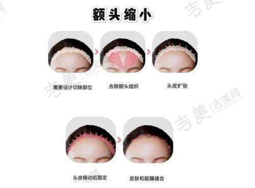珠海九龙整形医院怎么样？我体验后安利，张红艳隆鼻自然，周国伟吸脂塑形佳