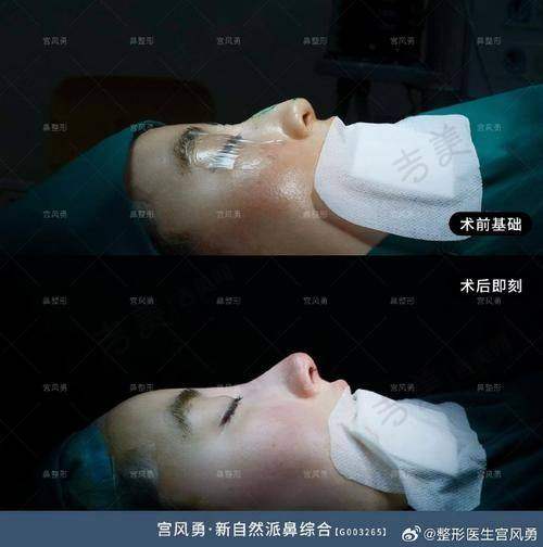 重庆华美紫馨整形美容驼峰鼻矫正32000元起是否划算
