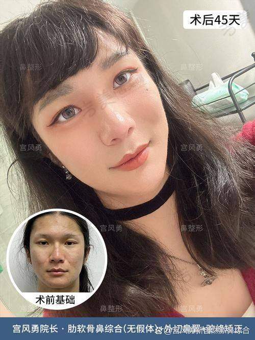 重庆华美紫馨整形美容驼峰鼻矫正32000元起优势体现
