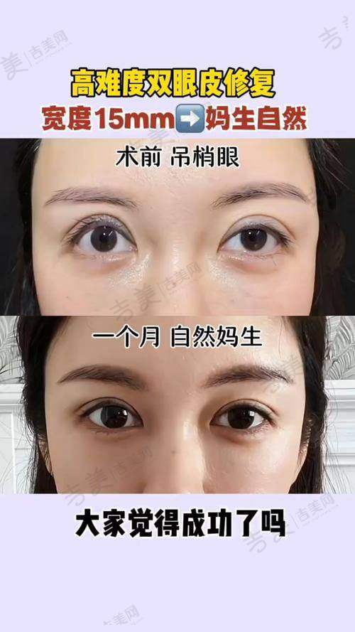黄晓光医生擅长的眼部整形项目