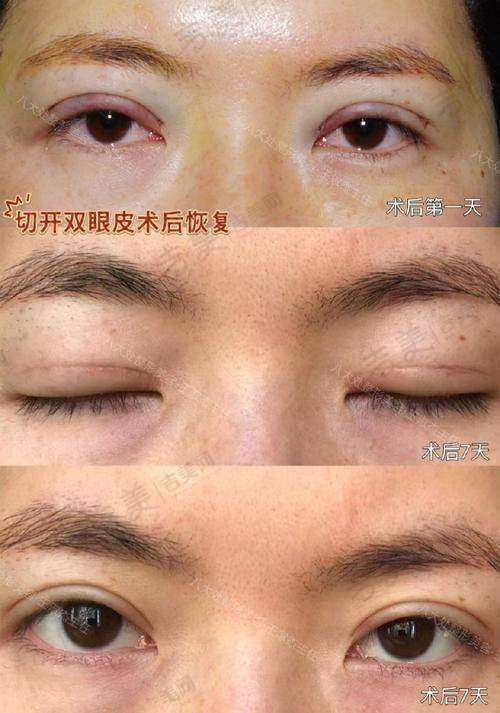 张志兵医生擅长的去眼袋及眼部整形项目