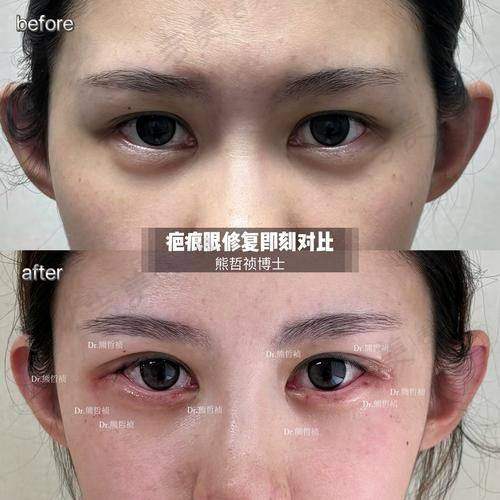 谭敏峰医生眼部多项手术范例参考