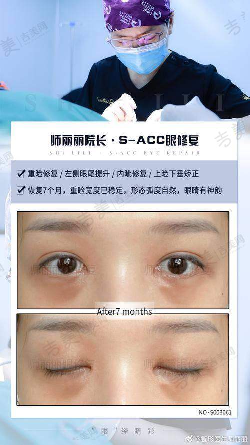 谭敏峰医生双眼皮手术的技术特色