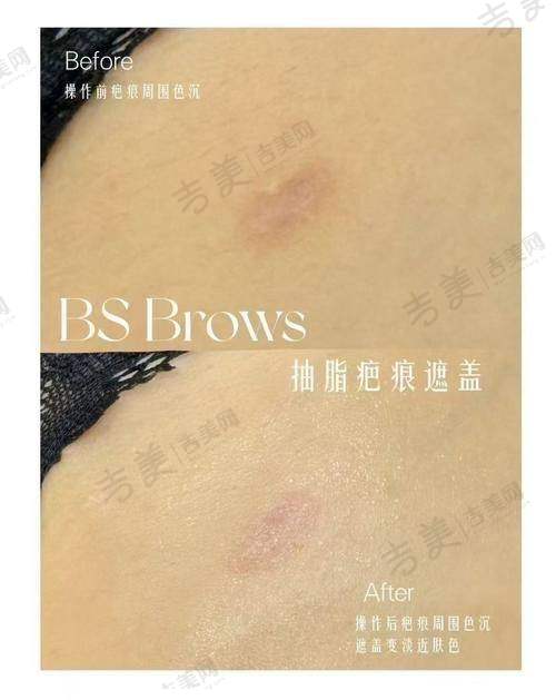 成都疤研疤痕医院的价格与性价比如何