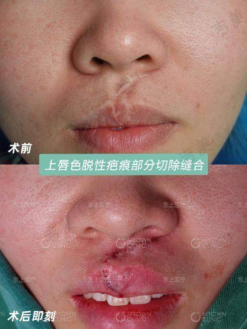 成都疤研疤痕医院治疗痛不痛，修复期要多久
