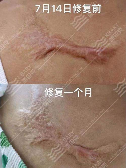 成都疤研疤痕医院的患者口碑怎么样