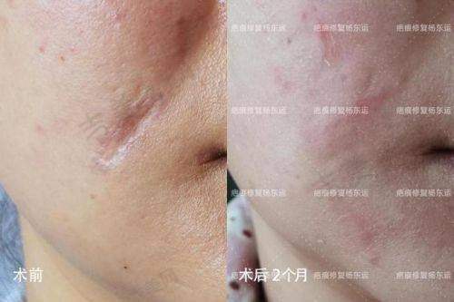 成都疤研疤痕医院的治疗技术有哪些