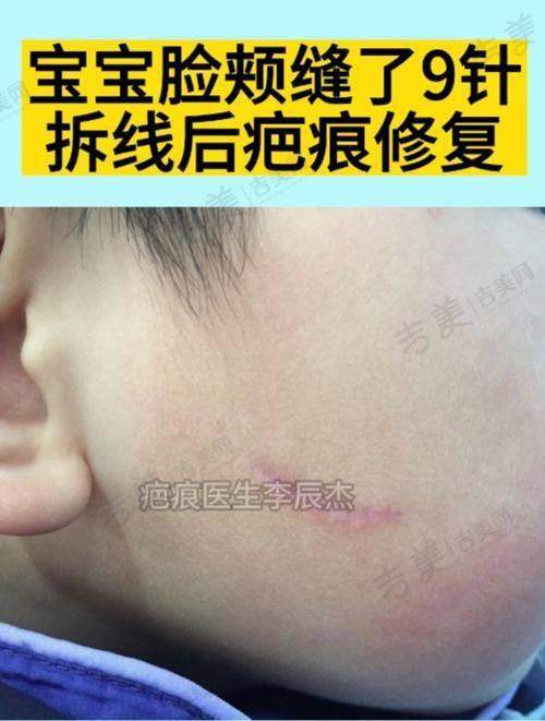 成都疤研疤痕医院是正规医院吗？资质设备双优，真人案例见证显著祛疤成效