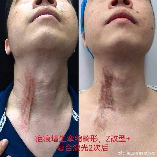 成都疤研疤痕医院收费贵吗