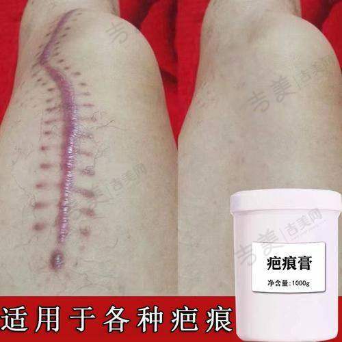成都疤研疤痕医院祛疤成效好吗