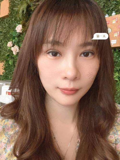 黄晓光医生不开刀去眼袋的技术优势