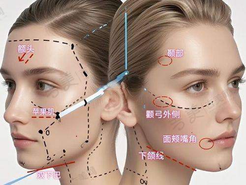 杨迪眼周筋膜提升成效好在哪?