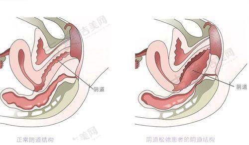 南京去眼袋骨干医生哪个好?鼓楼医院的实力担当