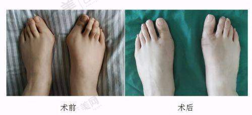 南京去眼袋骨干医生哪个好?真人实例见分晓