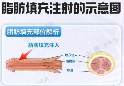 南宁华美整形美容医院隆胸收费标准解读