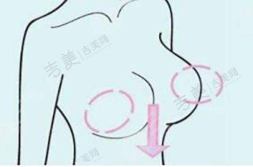 成都西区医院宋华敬抽脂术后修复快吗?