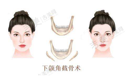 九、广东韩妃医疗美容医院——双眼皮修复与磨骨手术的明星医院