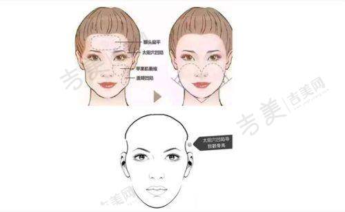 谢宏彬拉皮价格:不同方案的费用差别