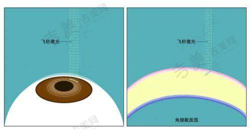 2025杭州白内障手术免费政策的申请流程是怎样的？