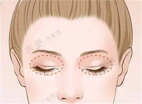 分享我在广州健丽去眼袋的经历：给有眼袋困扰者的建议