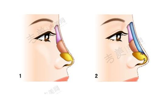 深圳名丽医疗美容医院鼻部整形有哪些优势