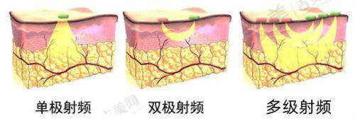 2025年深圳鹏程医院疤痕科全新价格表曝光：其他疤痕修复项目花费