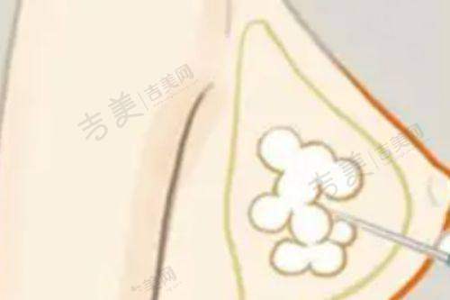 昆明维多利亚整形乳房再造83750元起医院实力