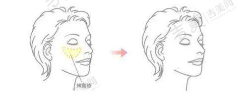 玻尿酸注射有哪些误区？